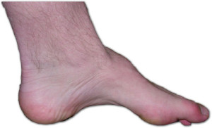 Charcot-marie-tooth_foot